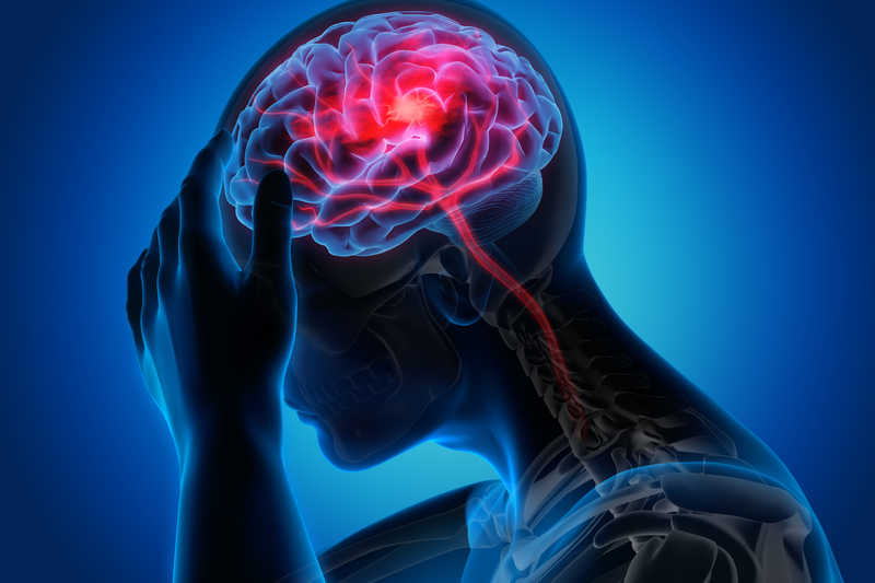 سکته مغزی  چیست ؟ علائم سکته مغزی + درمان انواع سکته مغزی