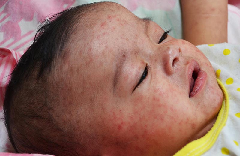 حساسیت در برابر بیماری سرخجه