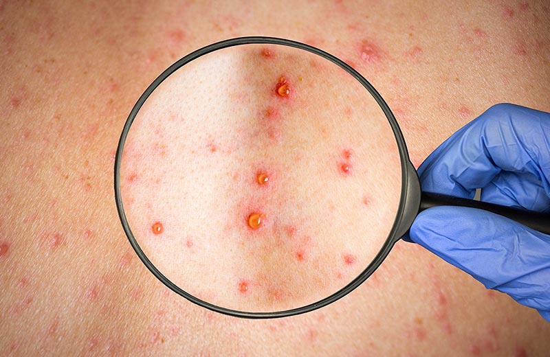 روش تشخیص سرخجه