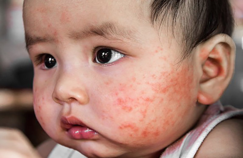 سرخجه در کودکان