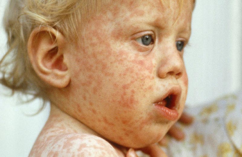 بیماری سرخجه در کودکان