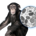 آبله میمونی چیست ؟ علائم بیماری آبله میمونی