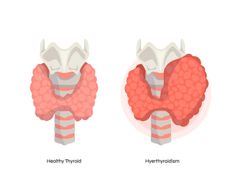 Thyroid treatment methods