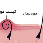 کیست مویی چیست؟ + علائم و درمان کیست مویی